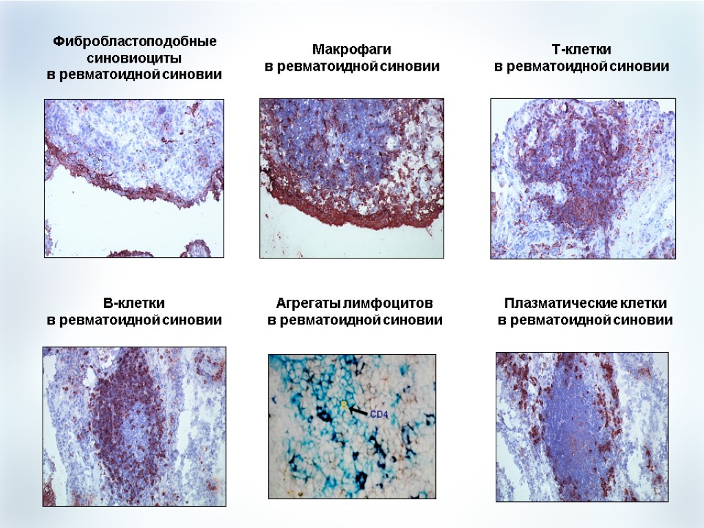 Фибробластоподобные синовиоциты в ревматоидной синовии Макрофаги в ревматоидной синовии Т-клетки в ревматоидной синовии В-клетки